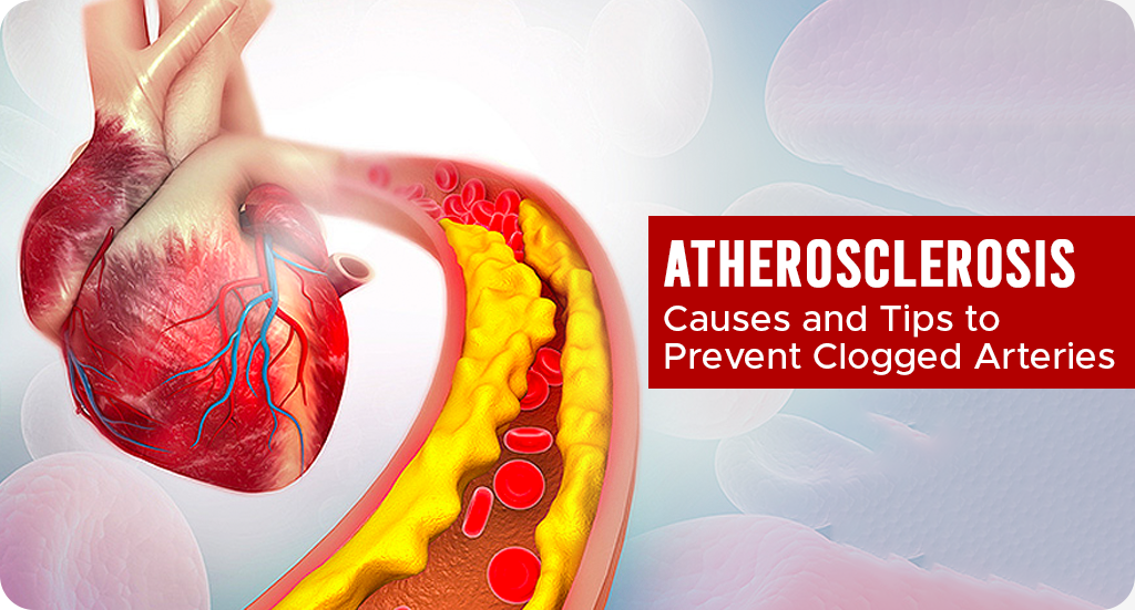 ATHEROSCLEROSIS: CAUSES AND TIPS TO PREVENT CLOGGED ARTERIES