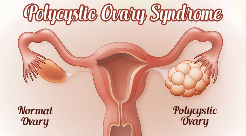 POLYCYSTIC OVARY SYNDROME (PCOS)