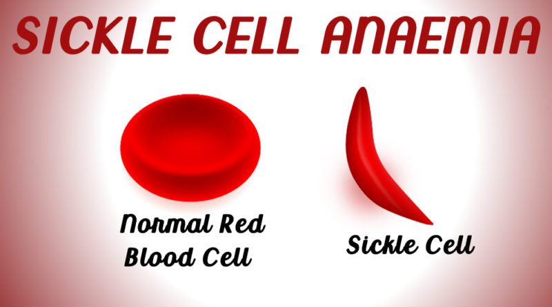 SICKLE CELL ANAEMIA